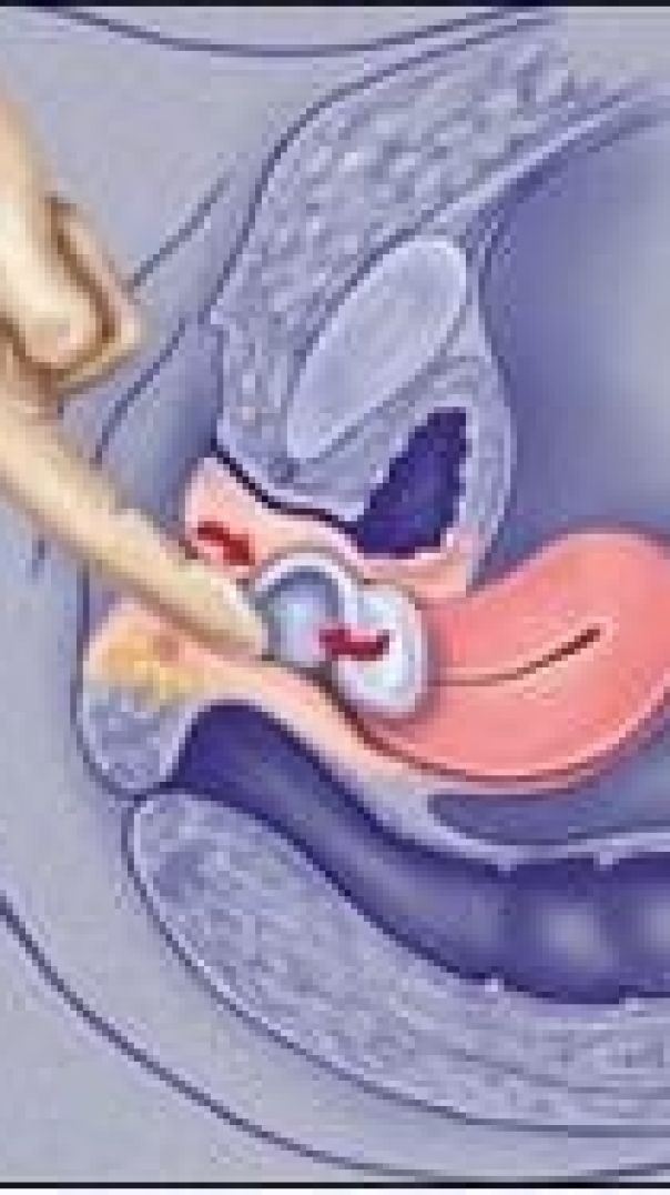 敏感覺醒膠囊塞劑使用秘籍，女性必看！