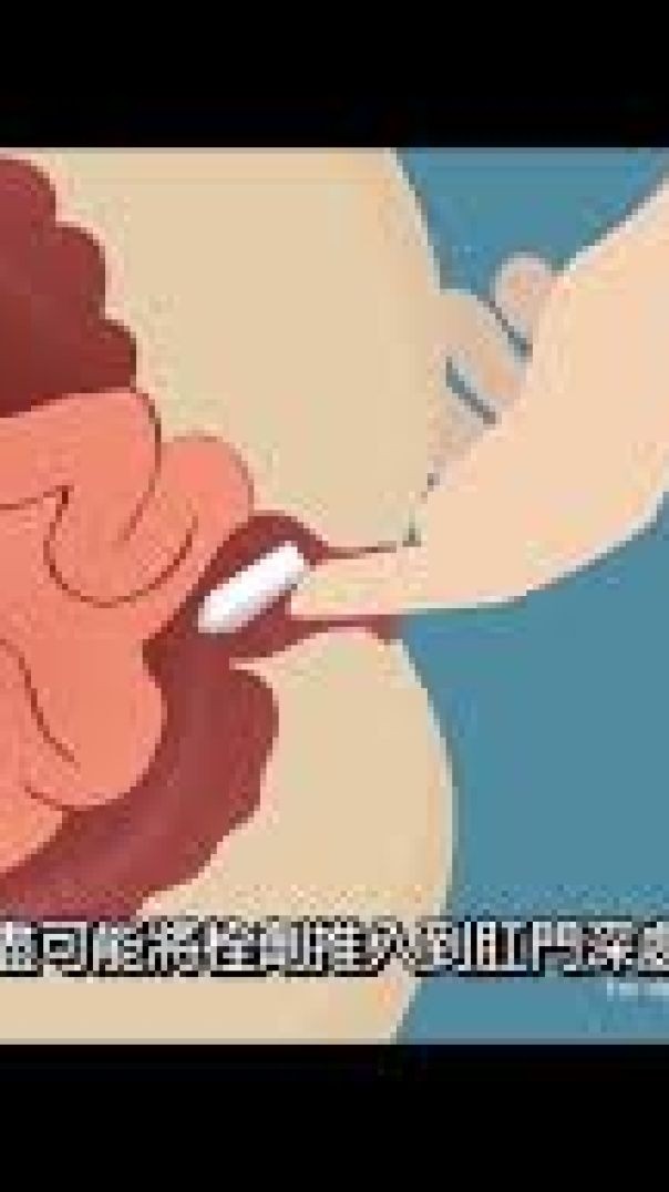 0號膠囊肛塞教學，讓你輕鬆上手